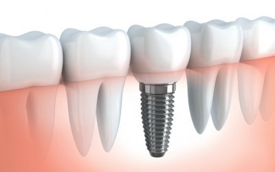 Implantologia Dentale