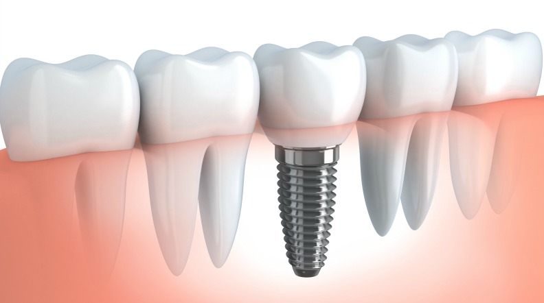 Implantologia Dentale