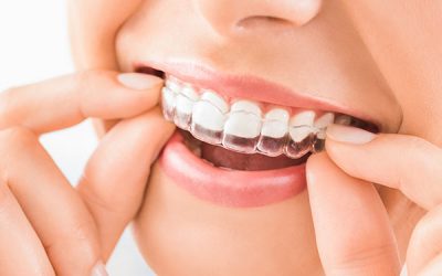 Ortodonzia e Trattamenti – La soluzione Invisibile per i tuoi denti