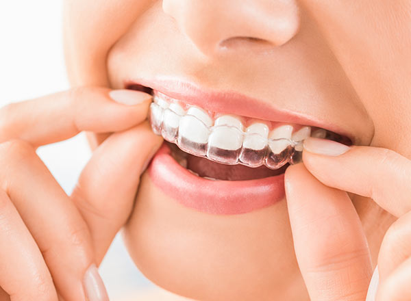 Ortodonzia e Trattamenti – La soluzione Invisibile per i tuoi denti